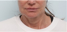 Facelift Before Photo by Paul Vitenas, Jr., MD; Houston, TX - Case 50072