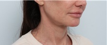 Facelift After Photo by Paul Vitenas, Jr., MD; Houston, TX - Case 50072