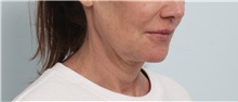 Facelift Before Photo by Paul Vitenas, Jr., MD; Houston, TX - Case 50072