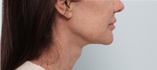 Facelift After Photo by Paul Vitenas, Jr., MD; Houston, TX - Case 50072