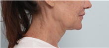 Facelift Before Photo by Paul Vitenas, Jr., MD; Houston, TX - Case 50072