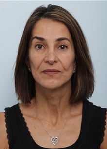 Facelift After Photo by Paul Vitenas, Jr., MD; Houston, TX - Case 50093 Facelift After Photo by Paul Vitenas, Jr., MD; Houston, TX - Case 50093