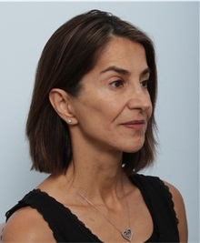 Facelift After Photo by Paul Vitenas, Jr., MD; Houston, TX - Case 50093