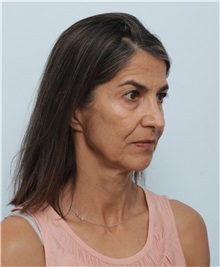 Facelift Before Photo by Paul Vitenas, Jr., MD; Houston, TX - Case 50093