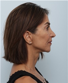 Facelift After Photo by Paul Vitenas, Jr., MD; Houston, TX - Case 50093