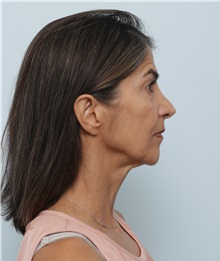 Facelift Before Photo by Paul Vitenas, Jr., MD; Houston, TX - Case 50093