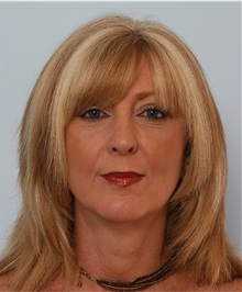 Rhinoplasty After Photo by Paul Vitenas, Jr., MD; Houston, TX - Case 50098
