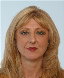 Rhinoplasty Before Photo by Paul Vitenas, Jr., MD; Houston, TX - Case 50098