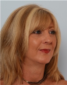 Rhinoplasty After Photo by Paul Vitenas, Jr., MD; Houston, TX - Case 50098