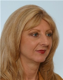 Rhinoplasty Before Photo by Paul Vitenas, Jr., MD; Houston, TX - Case 50098
