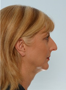 Rhinoplasty Before Photo by Paul Vitenas, Jr., MD; Houston, TX - Case 50098
