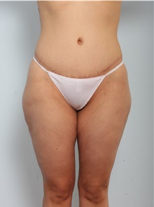 Body Lift After Photo by Paul Vitenas, Jr., MD; Houston, TX - Case 50097 Body Lift After Photo by Paul Vitenas, Jr., MD; Houston, TX - Case 50097