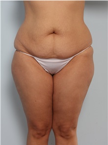 Body Lift Before Photo by Paul Vitenas, Jr., MD; Houston, TX - Case 50097 Body Lift Before Photo by Paul Vitenas, Jr., MD; Houston, TX - Case 50097