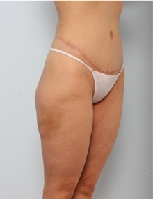 Body Lift After Photo by Paul Vitenas, Jr., MD; Houston, TX - Case 50097