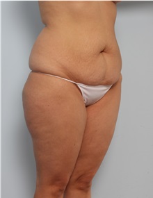 Body Lift Before Photo by Paul Vitenas, Jr., MD; Houston, TX - Case 50097