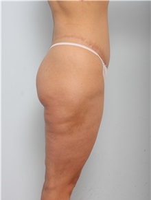 Body Lift After Photo by Paul Vitenas, Jr., MD; Houston, TX - Case 50097