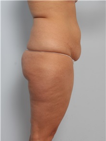 Body Lift Before Photo by Paul Vitenas, Jr., MD; Houston, TX - Case 50097