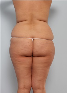 Body Lift Before Photo by Paul Vitenas, Jr., MD; Houston, TX - Case 50097