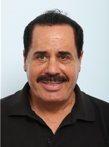 Facelift After Photo by Paul Vitenas, Jr., MD; Houston, TX - Case 50094