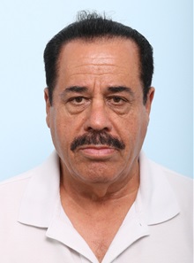 Facelift Before Photo by Paul Vitenas, Jr., MD; Houston, TX - Case 50094