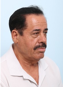Facelift Before Photo by Paul Vitenas, Jr., MD; Houston, TX - Case 50094