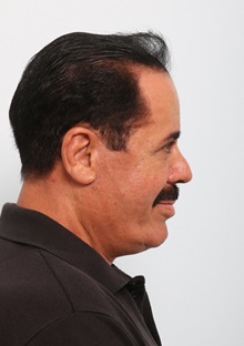 Facelift After Photo by Paul Vitenas, Jr., MD; Houston, TX - Case 50094