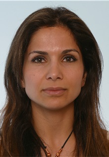 Rhinoplasty After Photo by Paul Vitenas, Jr., MD; Houston, TX - Case 50095
