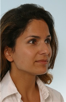 Rhinoplasty Before Photo by Paul Vitenas, Jr., MD; Houston, TX - Case 50095