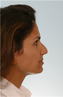 Rhinoplasty Before Photo by Paul Vitenas, Jr., MD; Houston, TX - Case 50095