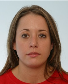 Rhinoplasty After Photo by Paul Vitenas, Jr., MD; Houston, TX - Case 50100