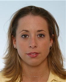 Rhinoplasty Before Photo by Paul Vitenas, Jr., MD; Houston, TX - Case 50100