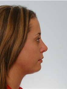 Rhinoplasty After Photo by Paul Vitenas, Jr., MD; Houston, TX - Case 50100