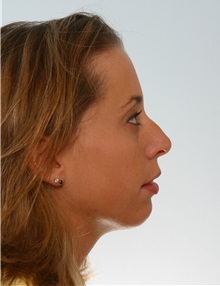Rhinoplasty Before Photo by Paul Vitenas, Jr., MD; Houston, TX - Case 50100