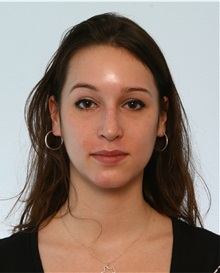 Rhinoplasty After Photo by Paul Vitenas, Jr., MD; Houston, TX - Case 50101