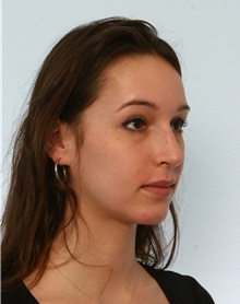 Rhinoplasty After Photo by Paul Vitenas, Jr., MD; Houston, TX - Case 50101