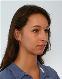 Rhinoplasty Before Photo by Paul Vitenas, Jr., MD; Houston, TX - Case 50101
