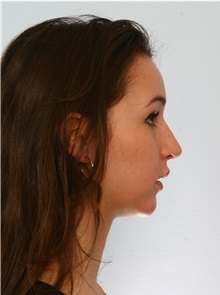 Rhinoplasty After Photo by Paul Vitenas, Jr., MD; Houston, TX - Case 50101