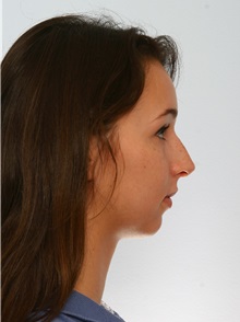 Rhinoplasty Before Photo by Paul Vitenas, Jr., MD; Houston, TX - Case 50101