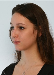 Rhinoplasty After Photo by Paul Vitenas, Jr., MD; Houston, TX - Case 50101