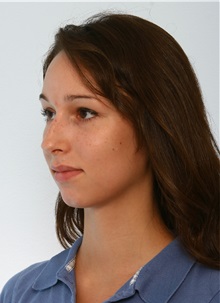 Rhinoplasty Before Photo by Paul Vitenas, Jr., MD; Houston, TX - Case 50101