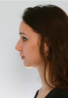 Rhinoplasty After Photo by Paul Vitenas, Jr., MD; Houston, TX - Case 50101