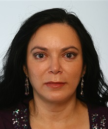 Rhinoplasty After Photo by Paul Vitenas, Jr., MD; Houston, TX - Case 50102
