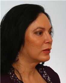 Rhinoplasty After Photo by Paul Vitenas, Jr., MD; Houston, TX - Case 50102