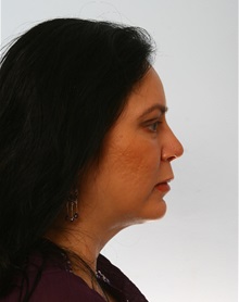 Rhinoplasty After Photo by Paul Vitenas, Jr., MD; Houston, TX - Case 50102