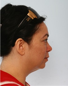 Rhinoplasty Before Photo by Paul Vitenas, Jr., MD; Houston, TX - Case 50102