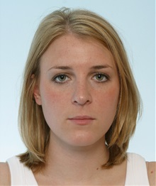 Rhinoplasty After Photo by Paul Vitenas, Jr., MD; Houston, TX - Case 50106 Rhinoplasty After Photo by Paul Vitenas, Jr., MD; Houston, TX - Case 50106