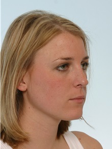 Rhinoplasty After Photo by Paul Vitenas, Jr., MD; Houston, TX - Case 50106