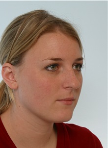 Rhinoplasty Before Photo by Paul Vitenas, Jr., MD; Houston, TX - Case 50106