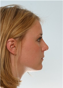 Rhinoplasty After Photo by Paul Vitenas, Jr., MD; Houston, TX - Case 50106