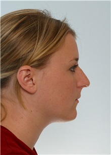 Rhinoplasty Before Photo by Paul Vitenas, Jr., MD; Houston, TX - Case 50106